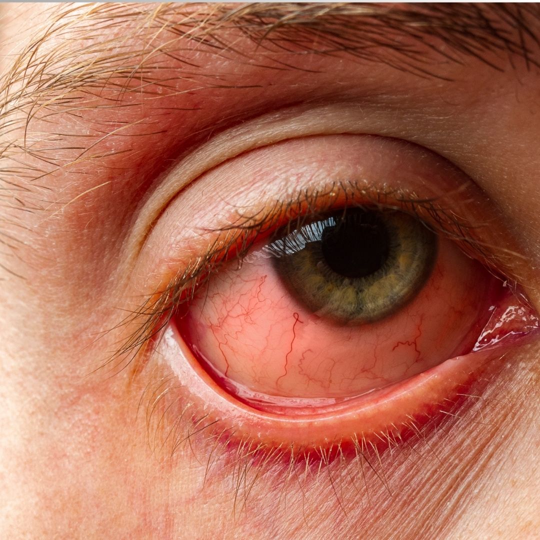 Olhos Vermelhos: Causas e Cuidados